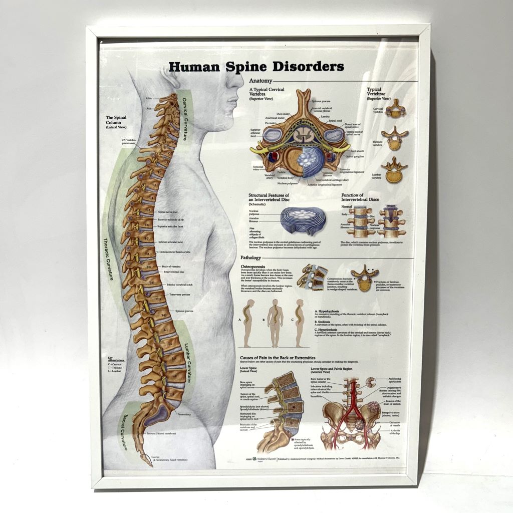 POSTER, Anatomical Framed A1 - HUMAN SPINE DISORDERS 